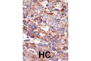 Formalin-fixed and paraffin-embedded human hepatocellular carcinoma tissue reacted with YY1 polyclonal antibody  , which was peroxidase-conjugated to the secondary antibody, followed by DAB staining . (YY1 Antikörper  (Internal Region))