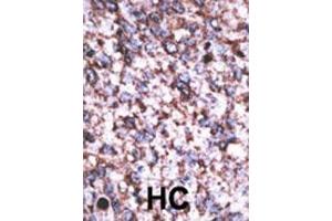 Formalin-fixed and paraffin-embedded human cancer tissue reacted with the primary antibody, which was peroxidase-conjugated to the secondary antibody, followed by AEC staining. (BACE2C Antikörper  (C-Term))