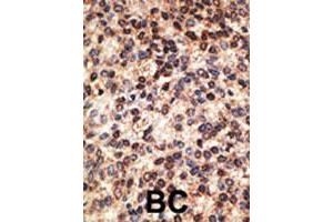 Formalin-fixed and paraffin-embedded human breast cancer tissue reacted with JAG2 polyclonal antibody  , which was peroxidase-conjugated to the secondary antibody, followed by DAB staining. (JAG2 Antikörper  (C-Term))