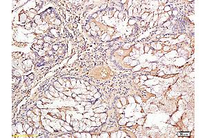 Formalin-fixed and paraffin embedded human rectal carcinoma labeled with Rabbit Anti TIMP-1 Polyclonal Antibody, Unconjugated (ABIN707441) at 1:200 followed by conjugation to the secondary antibody and DAB staining (TIMP1 Antikörper  (AA 131-207))