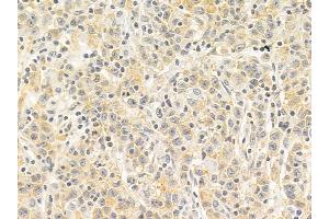 ADD1 Mouse Monoclonal Antibody at 1/100 staining human gastric cancer by IHC-P.
