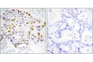 Immunohistochemistry analysis of paraffin-embedded human lung carcinoma tissue, using Retinoblastoma (Ab-249) Antibody. (Retinoblastoma Protein (Rb) Antikörper  (AA 211-260))