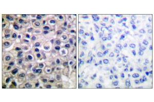 Immunohistochemical analysis of paraffin-embedded human breast carcinoma tissue using MMP-14 antibody (ABIN5976458). (MMP14 Antikörper  (C-Term))