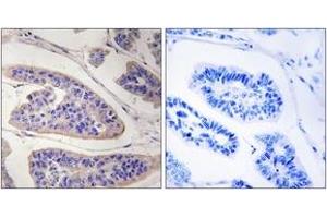 Immunohistochemistry analysis of paraffin-embedded human breast carcinoma tissue, using ENAH Antibody. (ENAH Antikörper  (AA 472-521))