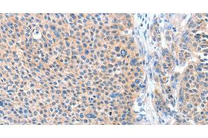 Immunohistochemistry of paraffin-embedded Human liver cancer tissue using ADAM20 Polyclonal Antibody at dilution 1:50 (ADAM20 Antikörper)