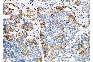 ABIN6264014 and ABIN6276720 at 1/100 staining Human ovarian cancer by IHC-P.