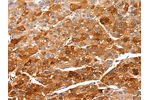 The image on the left is immunohistochemistry of paraffin-embedded Human liver cancer tissue using ABIN7128947(CIDEC Antibody) at dilution 1/50, on the right is treated with fusion protein. (CIDEC Antikörper)