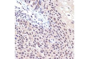Immunohistochemistry of paraffin-embedded human esophageal cancer using Transportin 3 (Transportin 3 (TNPO3)) Rabbit mAb (ABIN7270971) at dilution of 1:100 (40x lens). (Transportin 3 Antikörper)