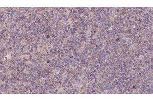 ABIN6273144 at 1/100 staining Human lymph cancer tissue by IHC-P.