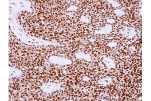 IHC-P Image Immunohistochemical analysis of paraffin-embedded human lung cancer, using APE1, antibody at 1:250 dilution. (APEX1 Antikörper  (Center))
