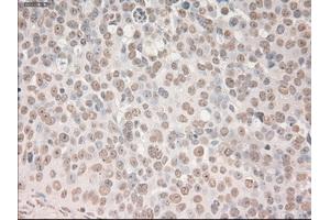 Immunohistochemical staining of paraffin-embedded Adenocarcinoma of breast tissue using anti-SOX17 mouse monoclonal antibody. (SOX17 Antikörper  (AA 177-414))