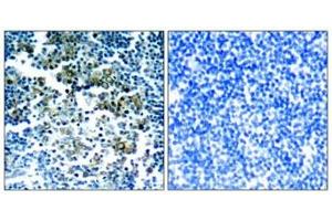 Immunohistochemical analysis of paraffin-embedded human tonsil tumor tissue using Bcr(Phospho-Tyr177) Antibody(left) or the same antibody preincubated with blocking peptide(right). (BCR Antikörper  (pTyr177))