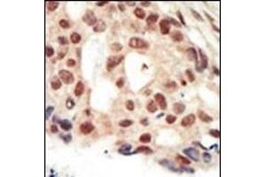 Formalin-fixed and paraffin-embedded human cancer tissue reacted with the primary antibody, which was peroxidase-conjugated to the secondary antibody, followed by AEC staining. (PRKG2 Antikörper  (C-Term))