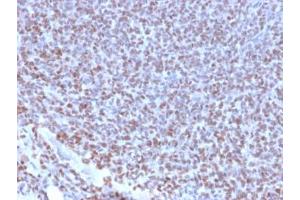 IHC testing of FFPE Ewings sarcoma with recombinant NKX2. (Nkx2-2 Antikörper  (AA 1-119))