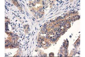 Immunohistochemical staining of paraffin-embedded Adenocarcinoma of Human colon tissue using anti-RTN4IP1 mouse monoclonal antibody. (RTN4IP1 Antikörper)