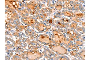 The image on the left is immunohistochemistry of paraffin-embedded Human thyroid cancer tissue using ABIN7128172(ACOX2 Antibody) at dilution 1/20, on the right is treated with fusion protein. (Acox2 Antikörper)