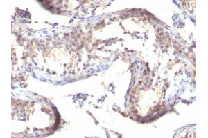Formalin-fixed, paraffin-embedded human Testicular Carcinoma stained with TGF alpha Mouse Monoclonal Antibody (MF9) (TGFA Antikörper  (C-Term))