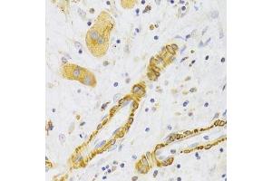 Immunohistochemistry of paraffin-embedded human liver cancer using KIF1B Antibody. (KIF1B Antikörper  (AA 1501-1770))