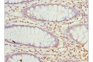 Immunohistochemistry of paraffin-embedded human colon cancer using ABIN7162928 at dilution of 1:100 (Peripherin Antikörper  (AA 1-260))
