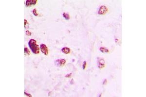 Immunohistochemical analysis of AP2 alpha/beta staining in human lung cancer formalin fixed paraffin embedded tissue section. (AP2 alpha/beta (C-Term) Antikörper)