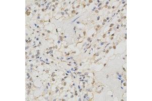Immunohistochemistry of paraffin-embedded human kidney cancer using MSH2 antibody at dilution of 1:200 (x400 lens). (MSH2 Antikörper)