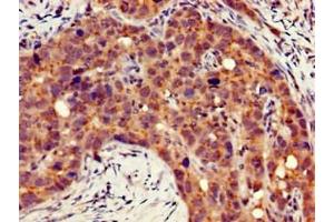 Immunohistochemistry of paraffin-embedded human pancreatic cancer using ABIN7156486 at dilution of 1:100 (Integrin beta 4 Antikörper  (AA 1401-1533))