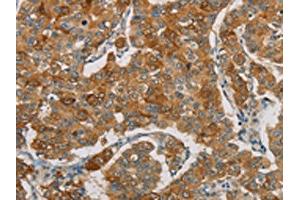 The image on the left is immunohistochemistry of paraffin-embedded Human breast cancer tissue using ABIN7190690(FOXF2 Antibody) at dilution 1/30, on the right is treated with synthetic peptide. (FOXF2 Antikörper)