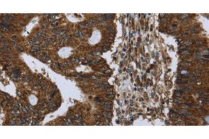 Immunohistochemistry of paraffin-embedded Human colon cancer using PPP1R13L Polyclonal Antibody at dilution of 1:30 (PPP1R13L Antikörper)