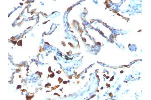 Formalin-fixed, paraffin-embedded human Lung Carcinoma stained with Milk Fat Globule Monoclonal Antibody (MFG-06) (MFGE8 Antikörper)