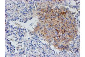 Immunohistochemical staining of paraffin-embedded Carcinoma of Human lung tissue using anti-RFXANK mouse monoclonal antibody. (RFXANK Antikörper)