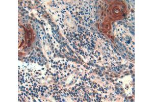 IHC-P analysis of skin cancer tissue, with DAB staining. (Follistatin Antikörper  (AA 35-283))