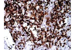 Immunohistochemical analysis of paraffin-embedded lung cancer tissues using CD2 mouse mAb with DAB staining. (CD2 Antikörper  (AA 25-140))