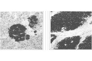 Left and Center: Immunohistochemical staining of normal pancreas tissue (left) and small bowel tumor tissue (center) using NSE antibody (X2070M and X2071M). (ENO2/NSE Antikörper)