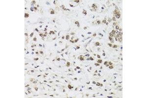 Immunohistochemistry of paraffin-embedded human gastric cancer using PPP1CC antibody at dilution of 1:100 (x40 lens). (PPP1CC Antikörper)
