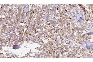 ABIN6276935 at 1/100 staining Human Melanoma tissue by IHC-P. (IL-24 Antikörper  (Internal Region))