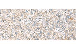Immunohistochemistry of paraffin-embedded Human liver cancer tissue using RAC2 Polyclonal Antibody at dilution of 1:60(x200) (RAC2 Antikörper)