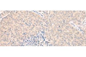 Immunohistochemistry of paraffin-embedded Human cervical cancer tissue using SEPT10 Polyclonal Antibody at dilution of 1:25(x200) (Septin 10 Antikörper)