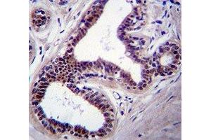 JNK1 antibody immunohistochemistry analysis in formalin fixed and paraffin embedded human breast tissue. (JNK Antikörper  (AA 358-389))