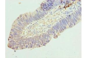 Immunohistochemistry of paraffin-embedded human ovarian cancer using ABIN7167036 at dilution of 1:100 (RINT1 Antikörper  (AA 401-700))