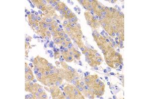 Immunohistochemistry of paraffin-embedded human gastric cancer using SMYD4 antibody. (SMYD4 Antikörper  (AA 1-260))