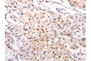 The image on the left is immunohistochemistry of paraffin-embedded Human breast cancer tissue using ABIN7191245(KRT6A/KRT6B/KRT6C/KRT6B/KRT6C Antibody) at dilution 1/40, on the right is treated with synthetic peptide. (KRT6A/KRT6B/KRT6C Antikörper)