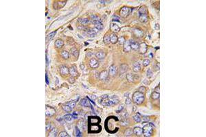 Formalin-fixed and paraffin-embedded human breast carcinoma tissue reacted with HSPB1 polyclonal antibody  , which was peroxidase-conjugated to the secondary antibody, followed by DAB staining. (HSP27 Antikörper  (Ser78))
