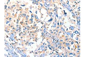 The image on the left is immunohistochemistry of paraffin-embedded Human esophagus cancer tissue using ABIN7129275(DUSP14 Antibody) at dilution 1/20, on the right is treated with fusion protein. (DUSP14 Antikörper)