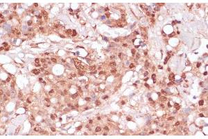 Immunohistochemistry of paraffin-embedded Human breast cancer using BYSL Polyclonal Antibody at dilution of 1:100 (40x lens). (Bystin-Like Antikörper)