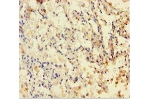 Immunohistochemistry of paraffin-embedded human lung cancer using ABIN7149900 at dilution of 1:100 (Dihydrofolate Reductase Antikörper  (AA 2-187))