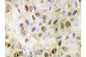 Immunohistochemistry analyzes of RORα antibody in paraffin-embedded human breast carcinoma tissue. (RORA Antikörper)