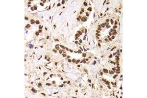 Immunohistochemistry of paraffin-embedded human breast cancer using ANP32A Antibody. (PHAP1 Antikörper)