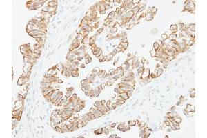 IHC-P Image Immunohistochemical analysis of paraffin-embedded human ovarian cancer, using Adenylate cyclase 2, antibody at 1:250 dilution. (ADCY2 Antikörper)