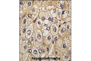 Formalin-fixed and paraffin-embedded human hepatocarcinoma tissue reacted with EphA7 antibody , which was peroxidase-conjugated to the secondary antibody, followed by DAB staining. (EPH Receptor A7 Antikörper)