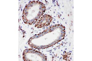 Anti-MTCO1 antibody, IHC(P): Human Mammary Cancer Tissue (COX1 Antikörper  (C-Term))